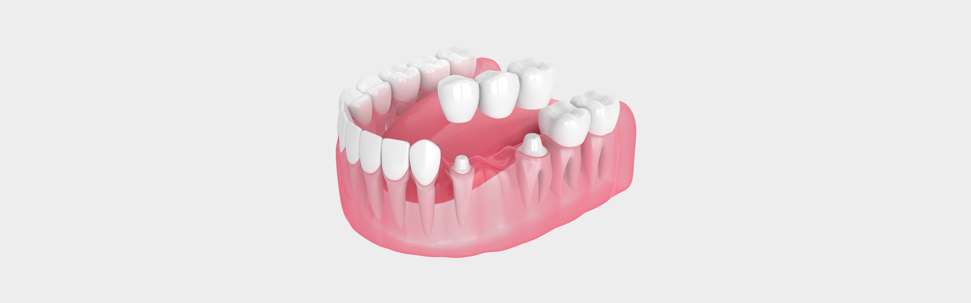 Dental Bridges in Bella Vista, AR