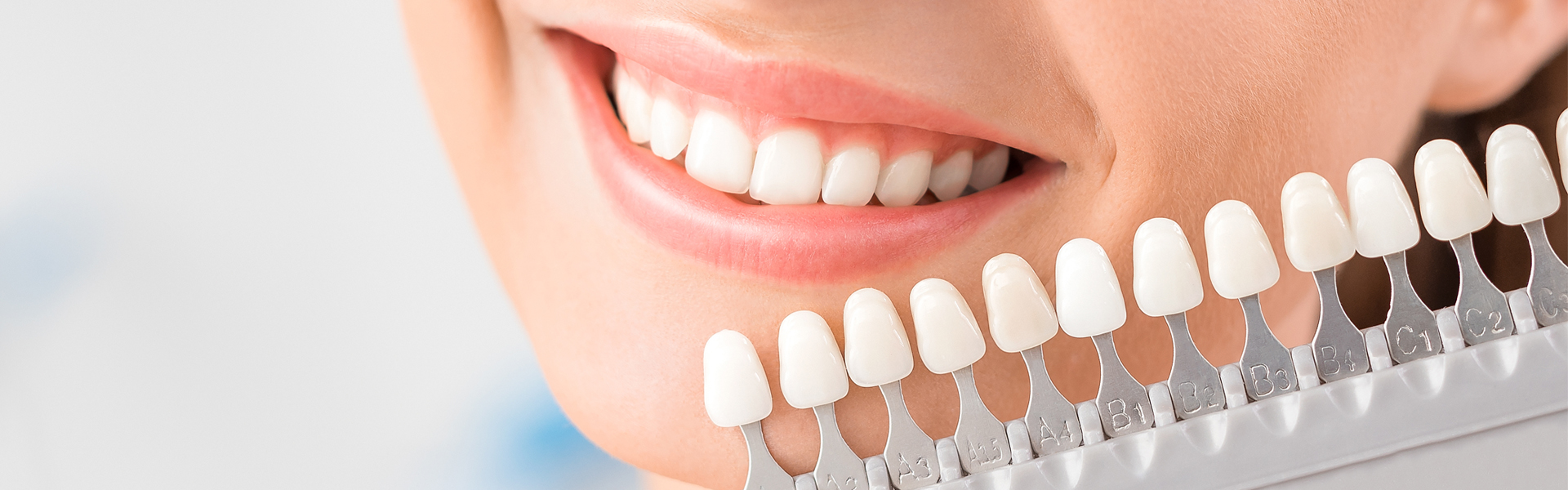 Dental Veneers in Bella Vista, AR