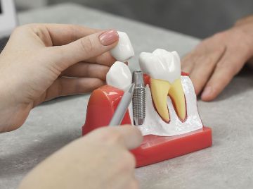 How to Maintain Your Dental Implants for Long-Term Success?